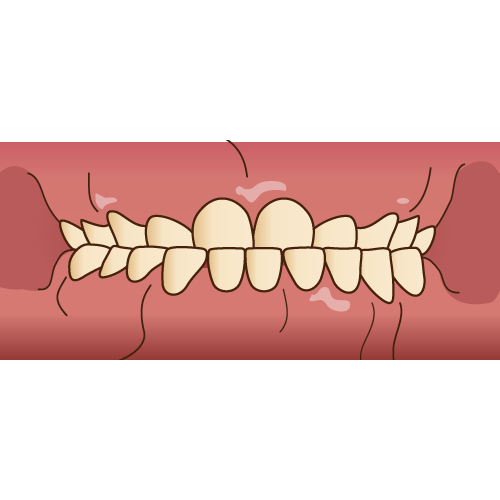 乳歯の受け口の治療について👄