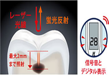 「むし歯探知機」でむし歯の進行度を見極める