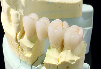 銀歯を使わずに歯を修復