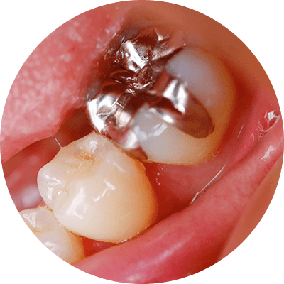歯の詰め物・被せ物