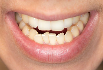乱れた歯並び・噛み合わせが及ぼす悪影響