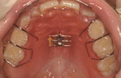 STEP.2 狭い顎の拡大や、顎の位置の修正