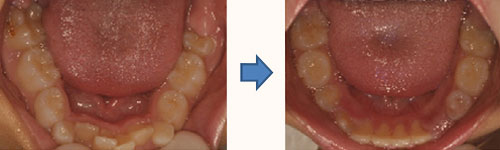 STEP.3 歯並びの調整