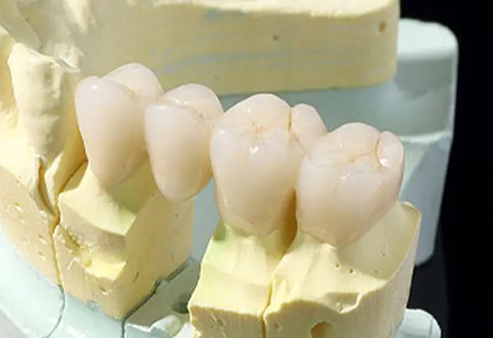 銀歯を使わずに歯を修復