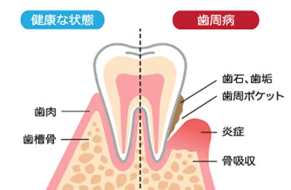 歯のクリーニング「PMTC」