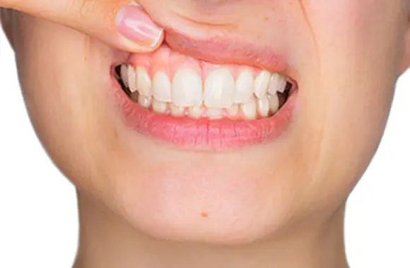 歯肉マッサージ