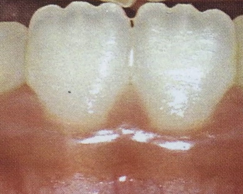 前歯使っていますか?🦷